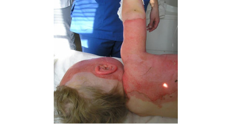 Treatment of Sasha K-noy's burns (Kyiv City Clinical Hospital No. 2)