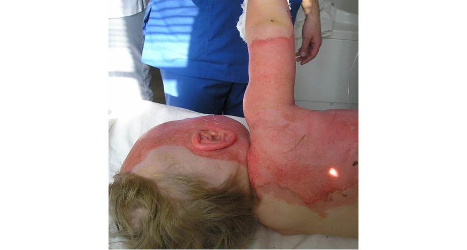 Treatment of Sasha K-noy's burns (Kyiv City Clinical Hospital No. 2)