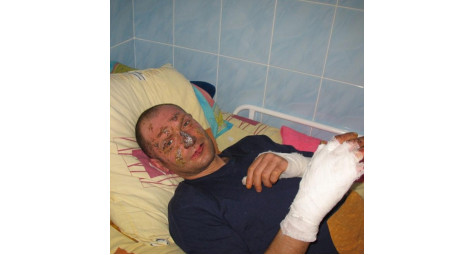 Treatment of burns on the hands of Sergei N-lov (Main Military Clinical Hospital, Kyiv)